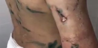 У пережившей пытки девочки из Ингушетии заметили улучшения