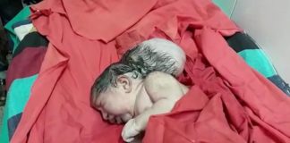 В Индии родилась девочка с «тремя головами»: опубликованы фото