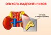Карцинома надпочечников: возможные причины, симптомы, лечение
