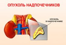 Карцинома надпочечников: возможные причины, симптомы, лечение