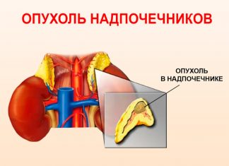 Карцинома надпочечников: возможные причины, симптомы, лечение